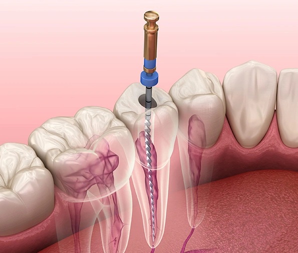 Endodontics