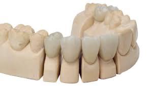 Dental prosthetics